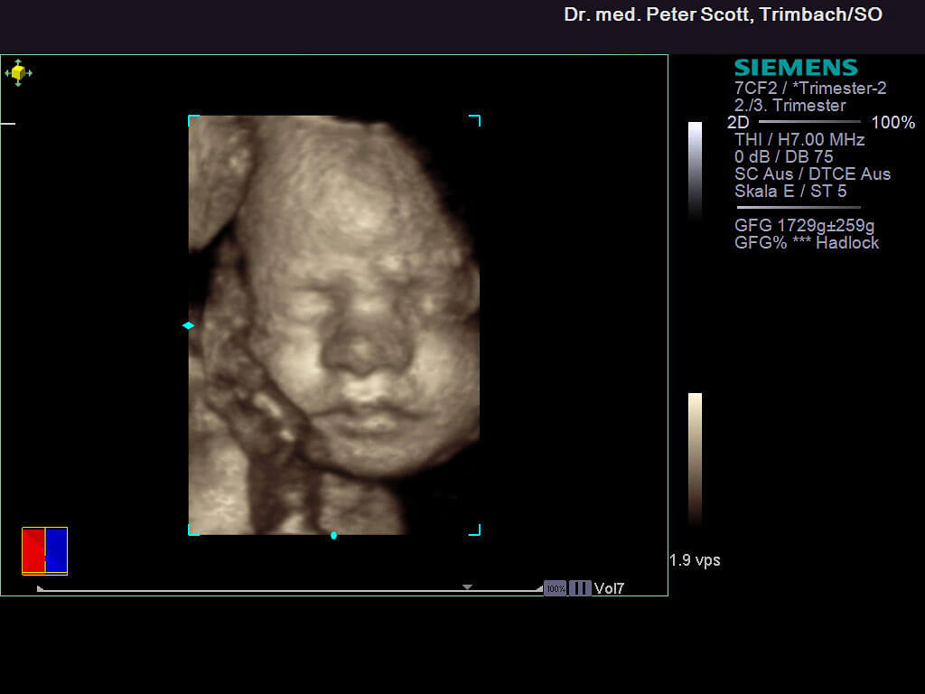  4D ultraschall 01