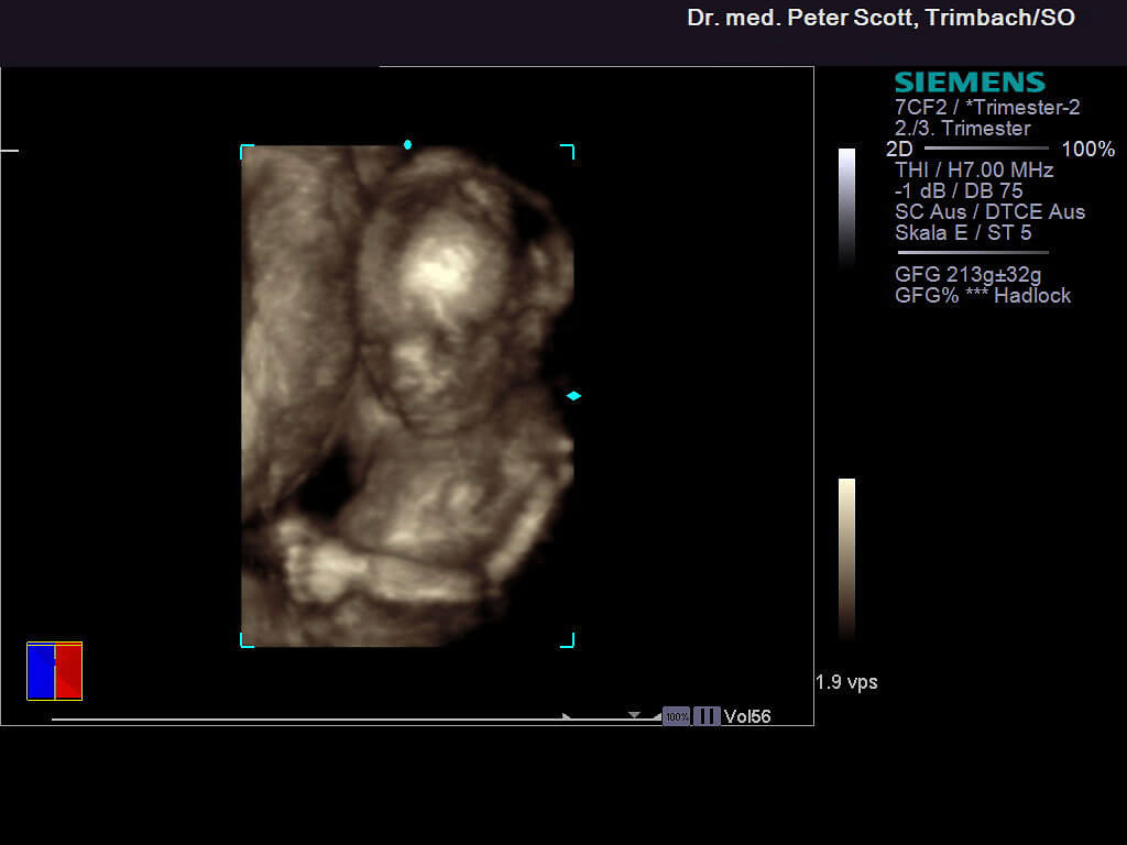 4D ultraschall 02
